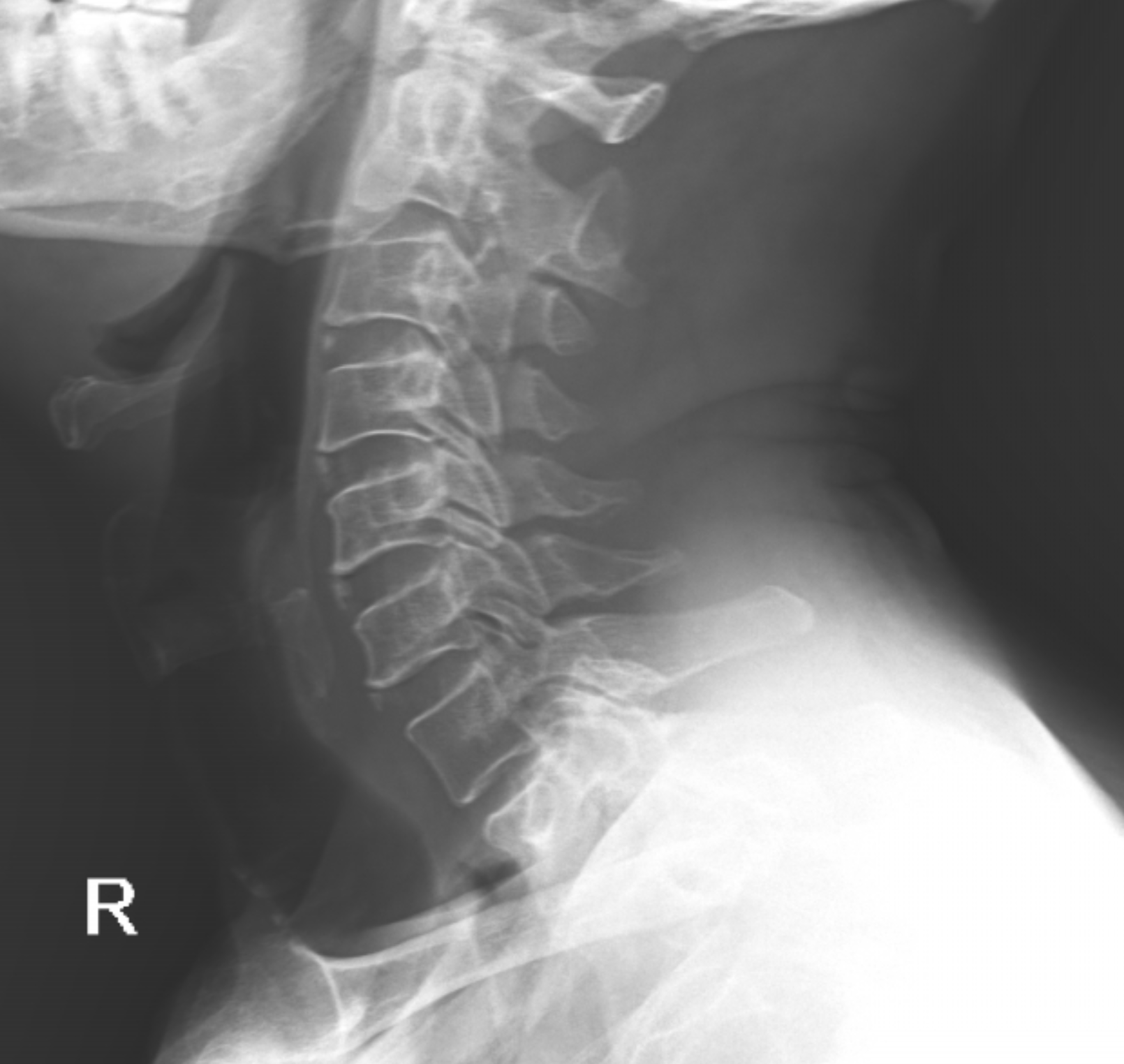 Cervical intercalary bone | Image | Radiopaedia.org