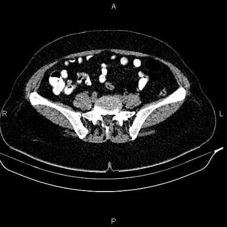 Appendiceal Mucocele | Image | Radiopaedia.org