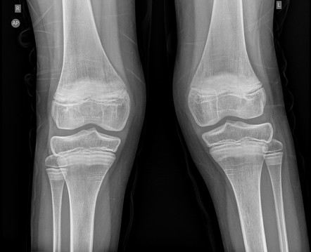 Dense metaphyseal bands | Radiology Case | Radiopaedia.org