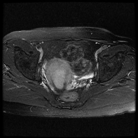 Endometrioid adenocarcinoma of the endometrium | Image | Radiopaedia.org