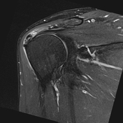 Hydroxyapatite deposition disease | Radiology Reference Article ...