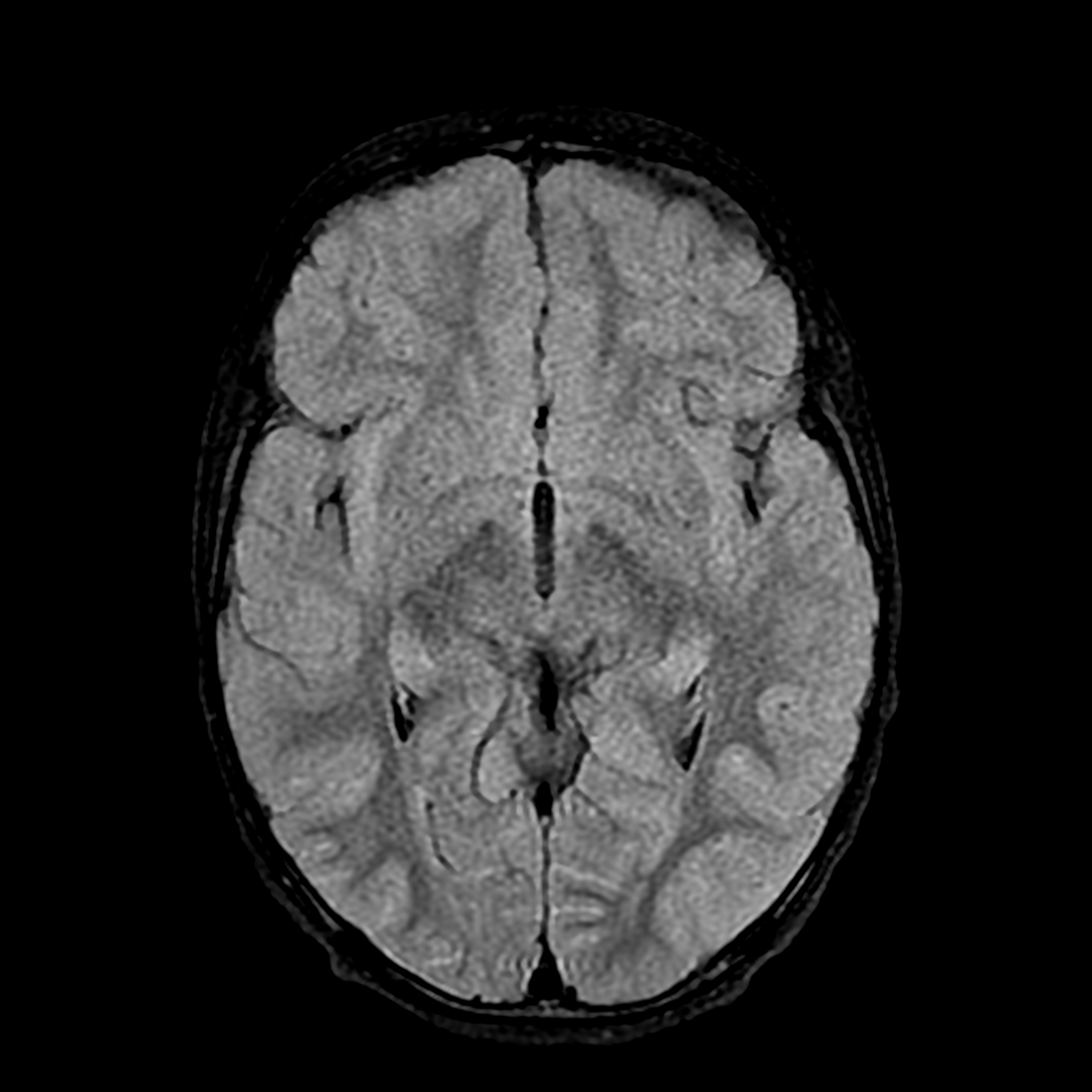 Pituitary Stalk Interruption Syndrome Image 9870