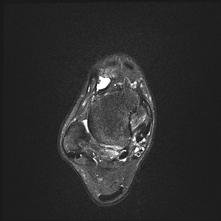 Os trigonum syndrome | Image | Radiopaedia.org