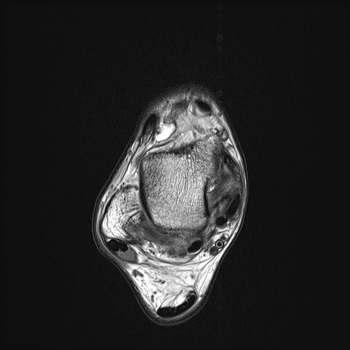 Os trigonum syndrome | Image | Radiopaedia.org