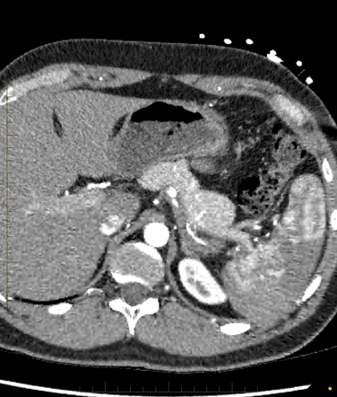 Segmental arterial mediolysis | Radiology Reference Article ...