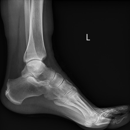 Midtarsal joint injury - extra-articular avulsion fractures | Image ...