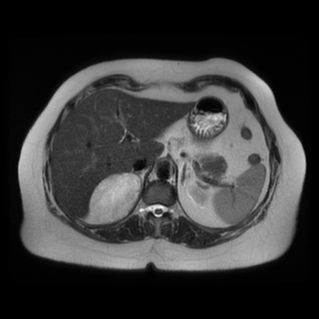 Adrenal myelolipoma - MRI | Image | Radiopaedia.org