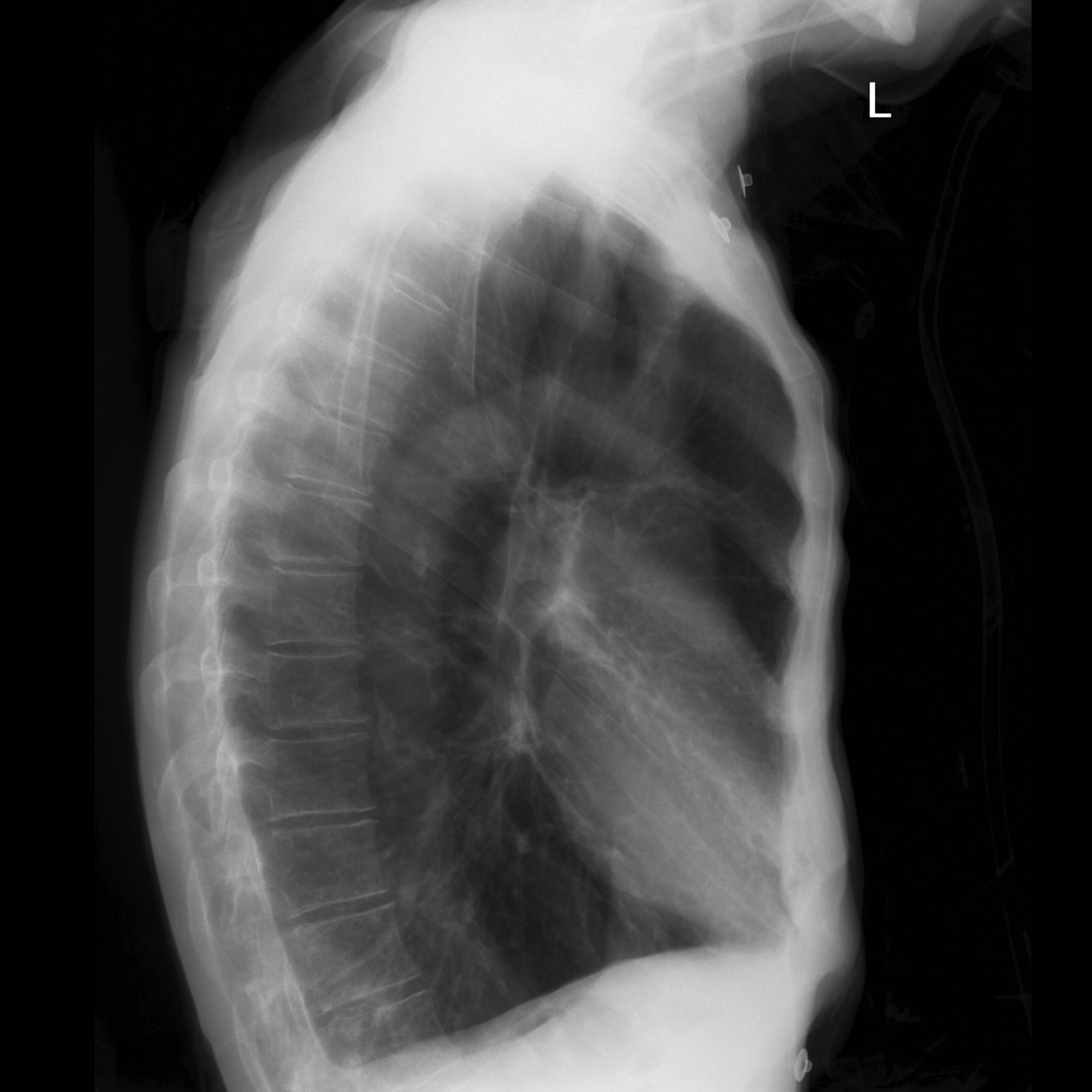 Causes Of Hyperinflation Chest X Ray at Peggy Close blog