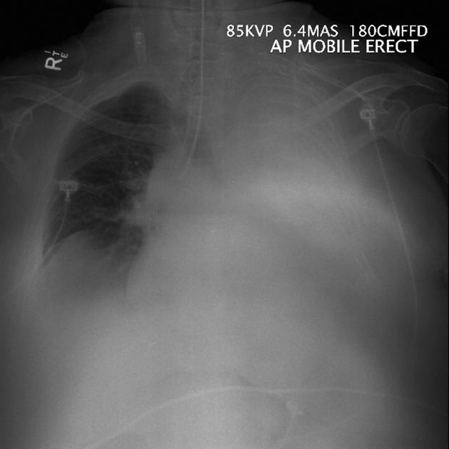 Hemithorax white-out (differential)