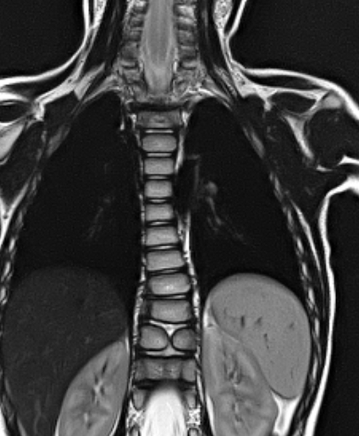 Butterfly vertebra | Radiology Reference Article | Radiopaedia.org