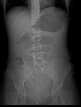 Mechanical bowel obstruction caused by a foreign body (clam shell ...