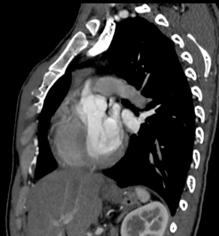 Aortic coarctation - ductal | Image | Radiopaedia.org