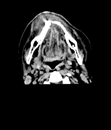 Periapical odontogenic abscess as incidental finding on trauma brain CT ...