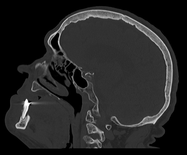 Periapical odontogenic abscess as incidental finding on trauma brain CT ...