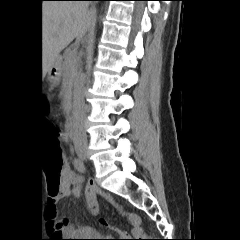 Schmorl node - acute | Image | Radiopaedia.org