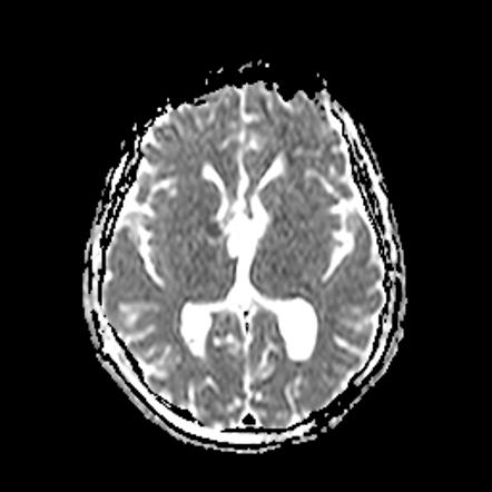 Colloid cyst - pre and post operative | Image | Radiopaedia.org