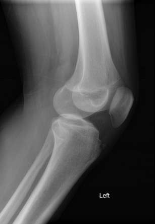 Osgood schlatter disease | Radiology Case | Radiopaedia.org