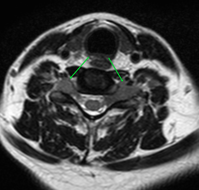 Neurolymphomatosis | Image | Radiopaedia.org