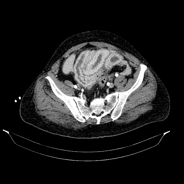 Shock bowel | Radiology Reference Article | Radiopaedia.org