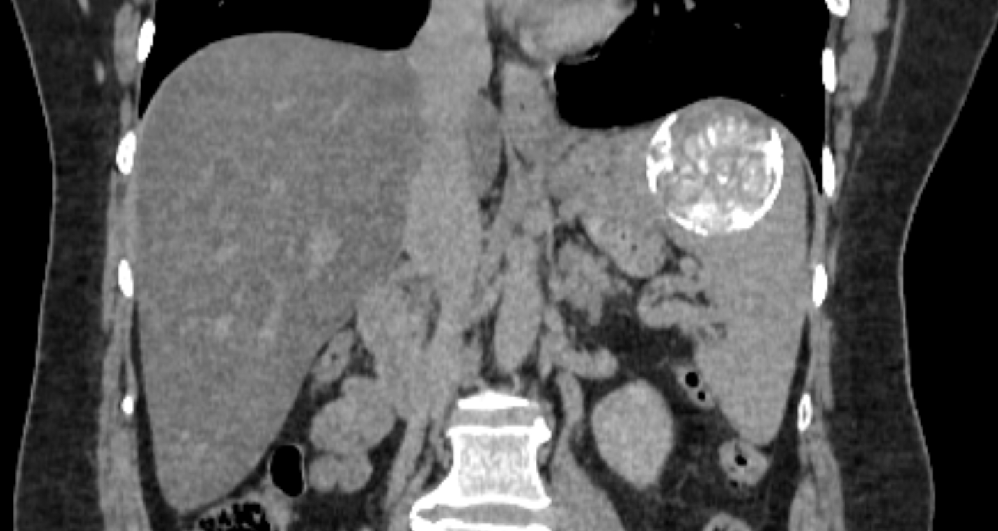 Calcified hydatid cyst of spleen | Image | Radiopaedia.org