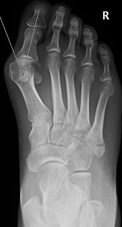 Hallux valgus | Radiology Reference Article | Radiopaedia.org