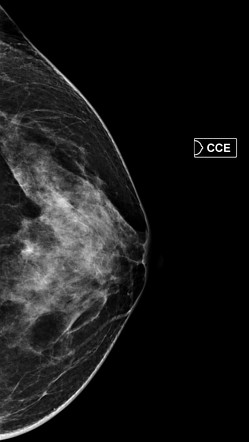 Ductal carcinoma in situ | Image | Radiopaedia.org