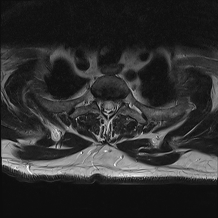 Cervical tumor-like myelopathy due to Type V dAVF | Image | Radiopaedia.org