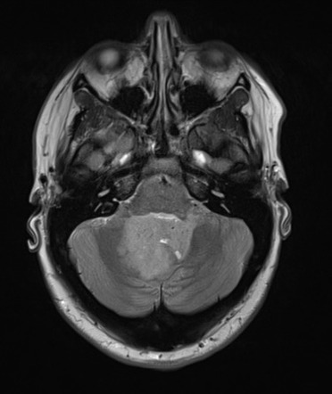 Cerebellar ependymoma complicated by post-operative subdural haematoma ...