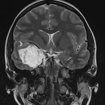 Epidermoid Cyst Of The Middle Cranial Fossa Radiology Case