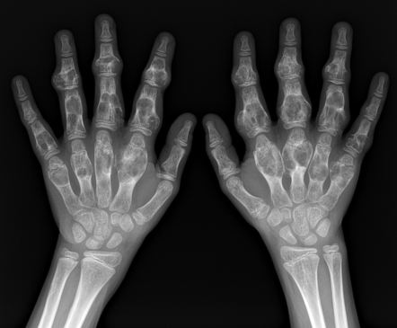 Ollier disease | Radiology Case | Radiopaedia.org