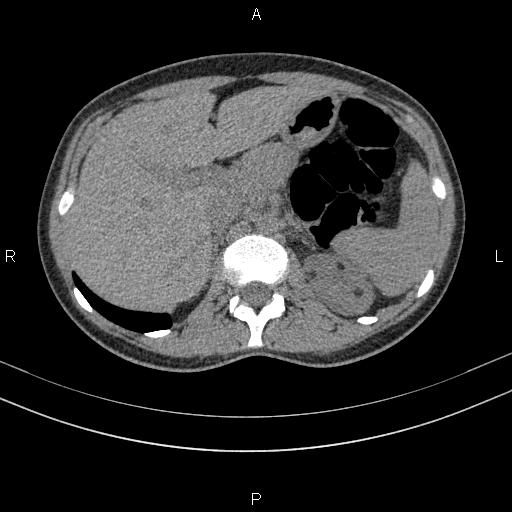 Lymphangioleiomyomatosis | Image | Radiopaedia.org