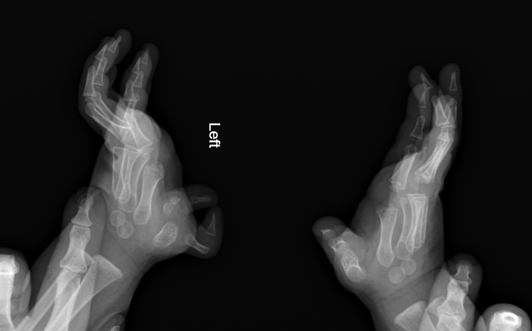 Pre-axial polydactyly and clinodactyly | Image | Radiopaedia.org