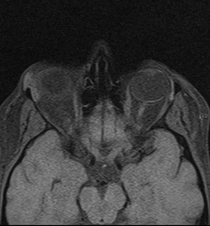 Orbital dermoid cyst - sack of marbles sign | Image | Radiopaedia.org