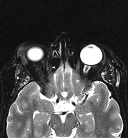 Orbital dermoid cyst - sack of marbles sign | Image | Radiopaedia.org