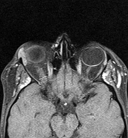 Orbital dermoid cyst - sack of marbles sign | Image | Radiopaedia.org