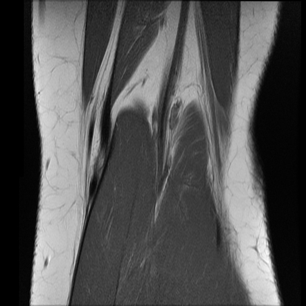 Hyperextension knee injury | Image | Radiopaedia.org