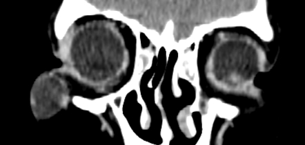 External angular dermoid | Radiology Case | Radiopaedia.org