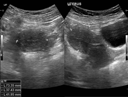 Embedded intrauterine contraceptive device | Radiology Reference ...