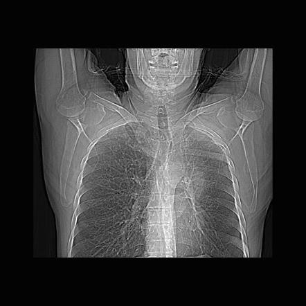 Left upper lobe collapse | Radiology Case | Radiopaedia.org