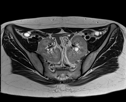 Mayer-Rokitansky-Küster-Hauser syndrome | Radiology Reference Article ...