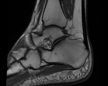 Accessory Navicular Syndrome Image Radiopaedia Org