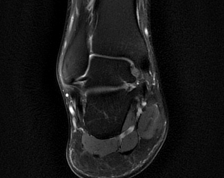 Accessory Navicular Syndrome Image Radiopaedia Org