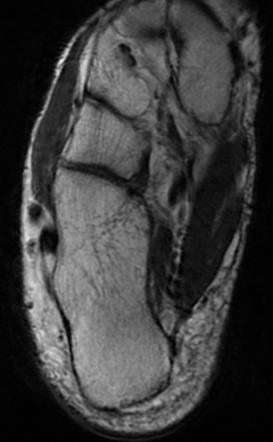 Accessory Navicular Syndrome Image Radiopaedia Org