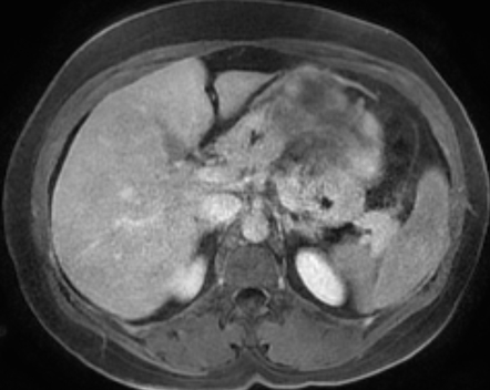 Hepatic hemangiomas - focal nodular hyperplasia | Image | Radiopaedia.org