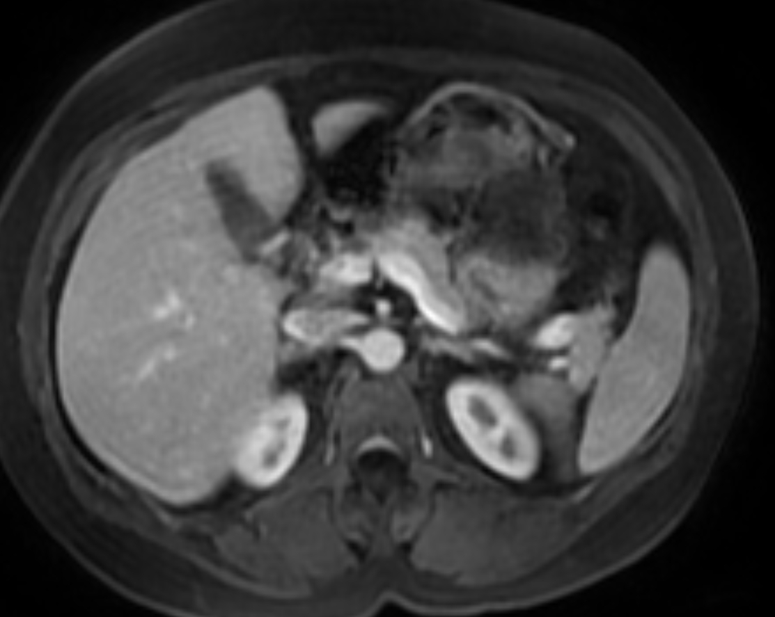 Hepatic hemangiomas - focal nodular hyperplasia | Image | Radiopaedia.org