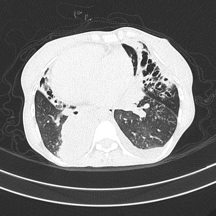 Kartagener Syndrome Image Radiopaediaorg