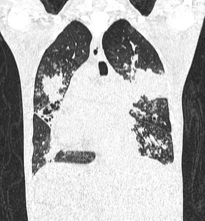 Kartagener syndrome | Radiology Reference Article | Radiopaedia.org