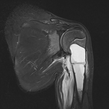 Bone Cyst Mri