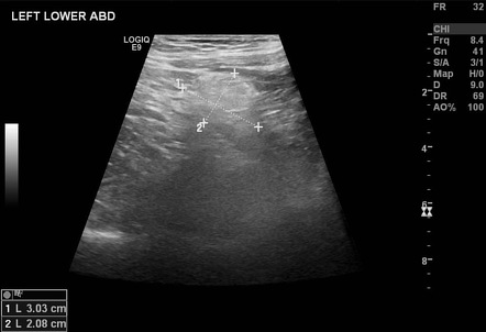 Acute epiploic appendagitis | Radiology Case | Radiopaedia.org