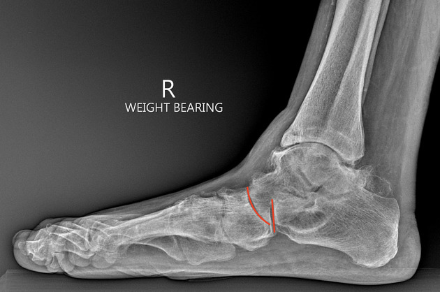 Chopart fracture dislocation Radiology Reference Article